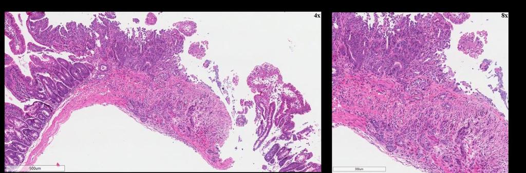 Figure 6.14 Adenocarcinoma in the duodenum region of a tamoxifen treated BRaf VE /p19 null mouse.
