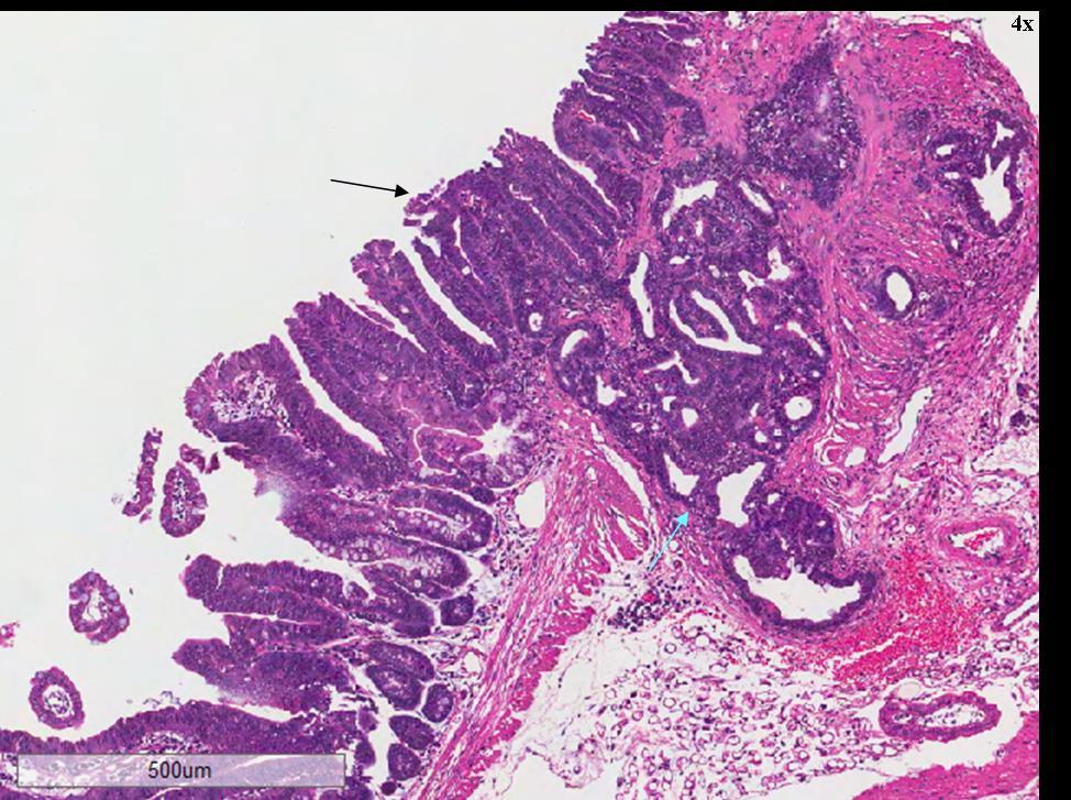 Figure 6.16 TSA HGD with early carcinoma. The TSA was identified in the proximal duodenum of a tamoxifen treated mouse, which was 80.71 weeks old.