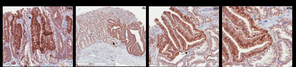 Figure 6.23 - β-catenin expression in a TSA and adenocarcinoma from BRaf CA /p16 mice (n = 14).
