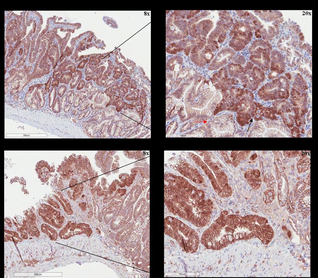 Figure 6.24 IHC analysis of β-catenin in a TSA and an adenocarcinoma detected in BRaf CA /p19 mice (n = 6).