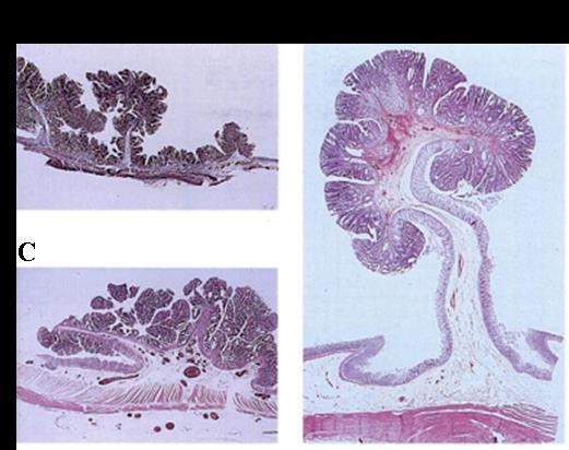 Figure 1.10 Structural classification of adenomas. Sessile adenoma (attached to the base- no stalk) (A). Pedunculated adenoma (attached by a very long stalk) (B).