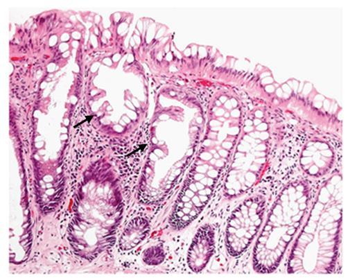 Figure 1.11 - Hyperplastic polyp (HP). A characteristic feature of HP is the infolding of the epithelial crypt as seen on the left (arrows) giving rise to a serrated appearance.