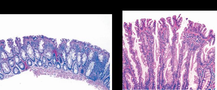 Figure 1.12 - Classification of HPs. Goblet cell HP (GCHP) - this polyp was located in the rectum with KRAS mutation in codon 12 and is CIMP-negative.
