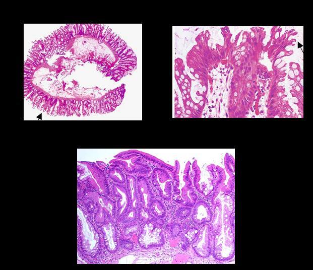 Ki-67 (Chung et al, 2008; Higuchi et al, 2005). A large number of SSAs also show a strong staining pattern (>76%) with MUC2 (intestinal mucin) and MUC5AC (gastric mucin).