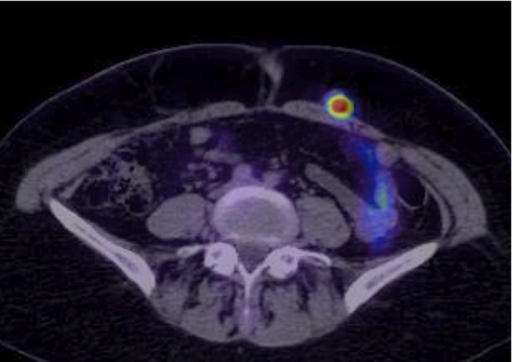 Fig. 8: Axial CT-PET image showing increased