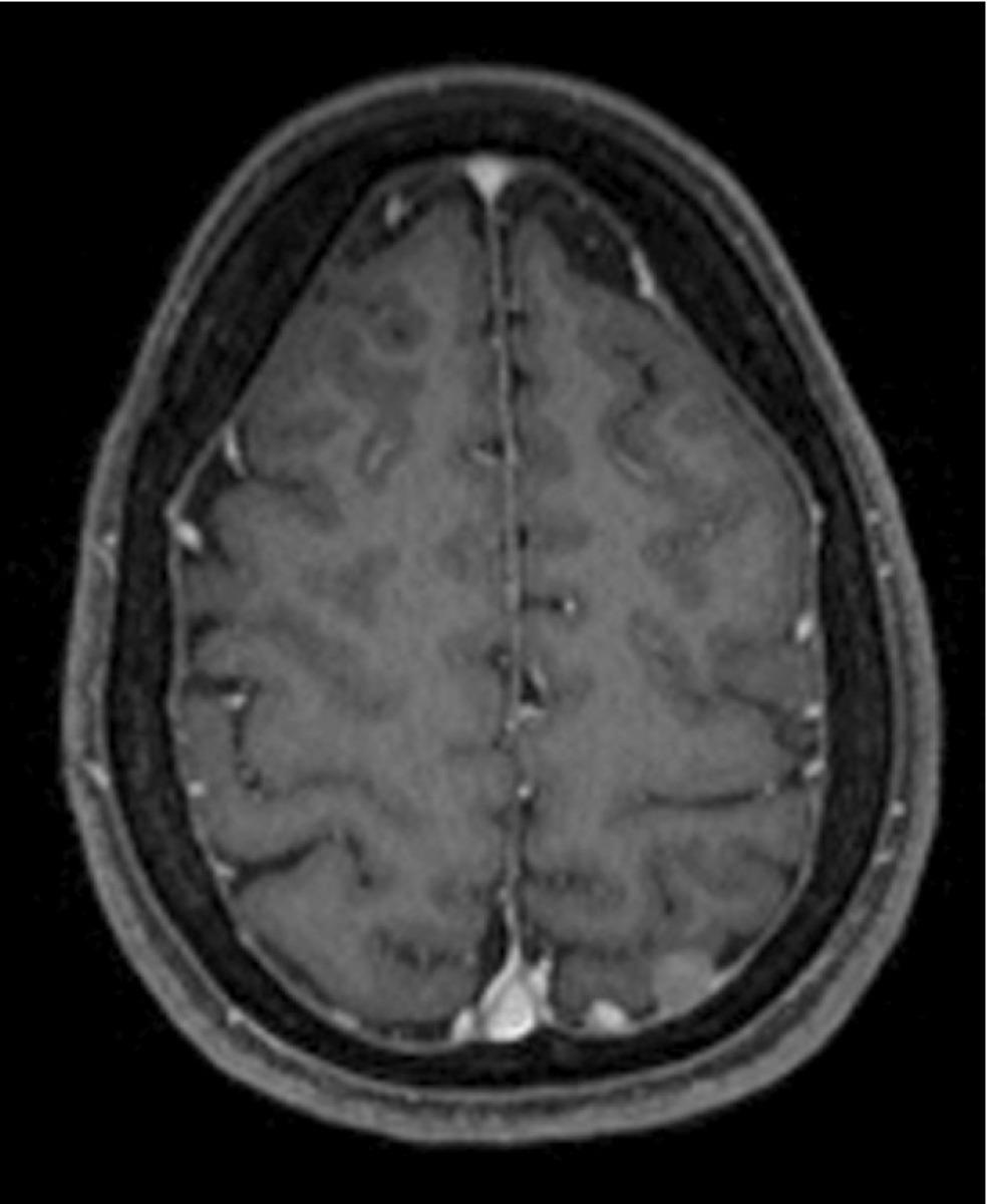 Fig. 9: Axial T1W, contrast-enhanced MRI image showing a