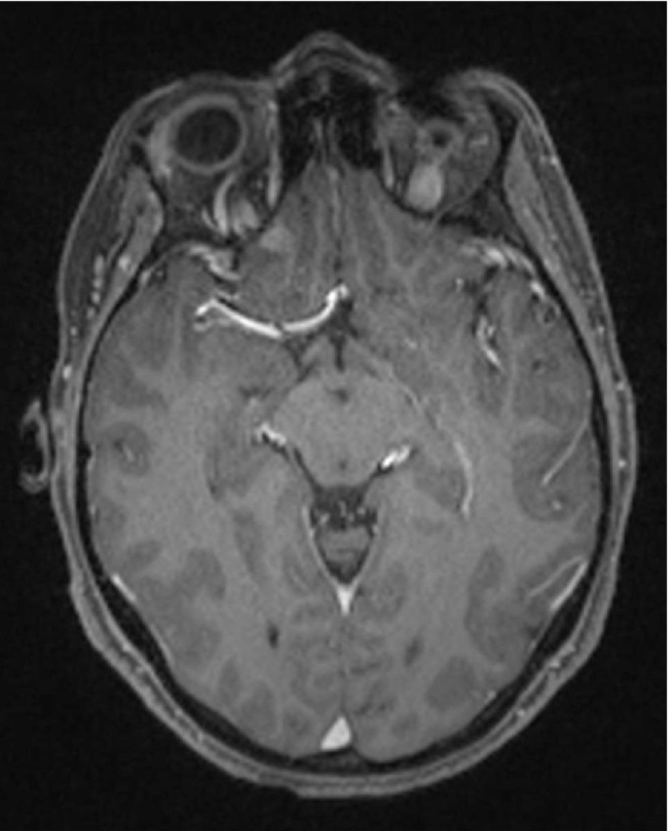 Fig. 10: Axial T1W, contrast-enhanced MRI image of the head