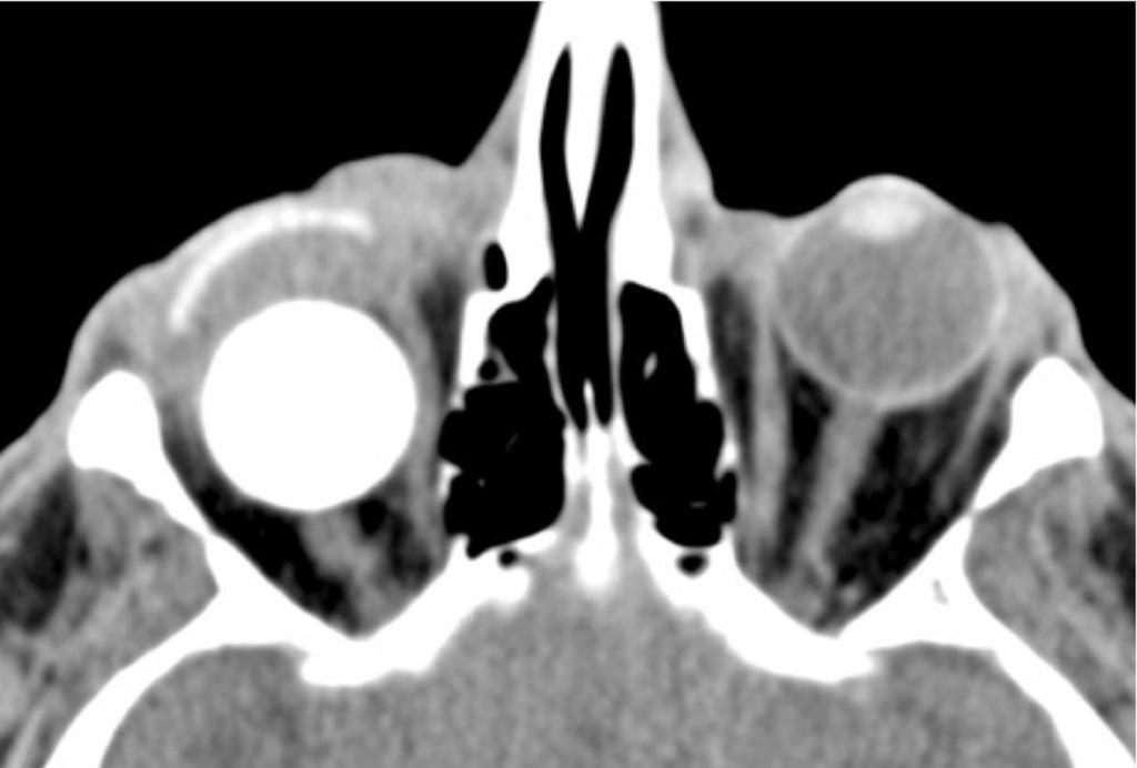 Fig. 11: Axial CT image of the orbits, soft tissue window, showing a
