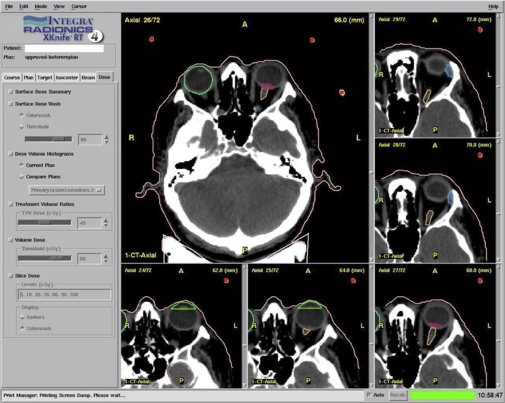 Fig. 14: Images from stereotactic radiotherapy planning software showing isodose lines Late side-effects or radiotherapy include retinopathy and complications thereof (vitreous haemorrhage and
