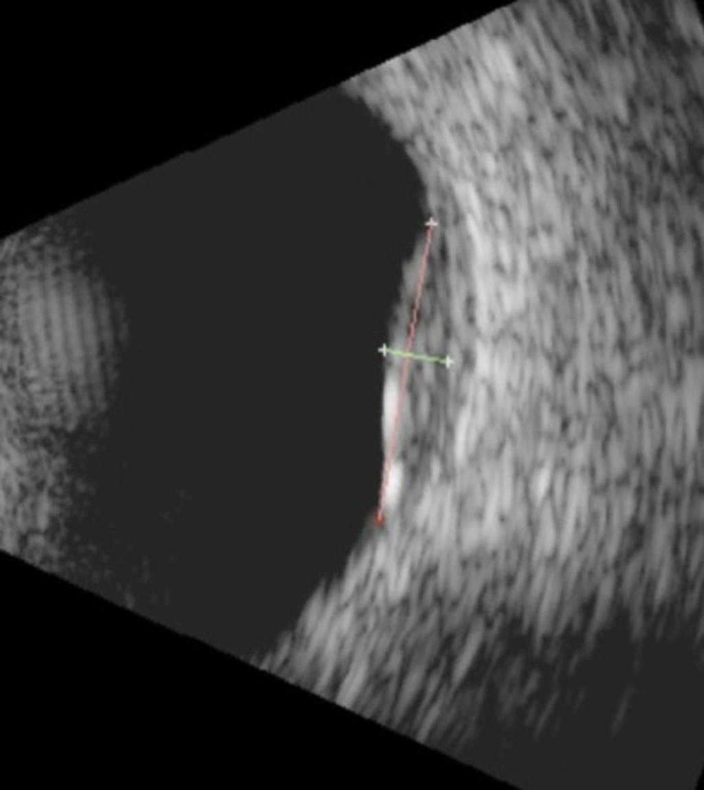 Fig. 15: Ultrasound image of the globe showing a small choroidal melanoma with measurements of thickness and basal diameter As the globe is