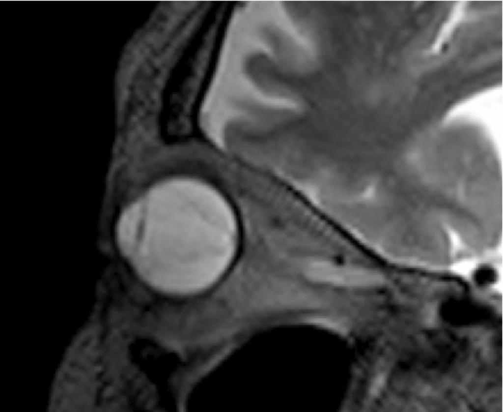 Fig. 2: Oblique sagittal T2W MRI image