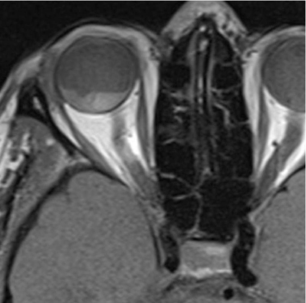 Fig. : Axial T1W MRI image showing a choroidal melanoma, retinal detachment and haemorrhage Diagnosis and differential