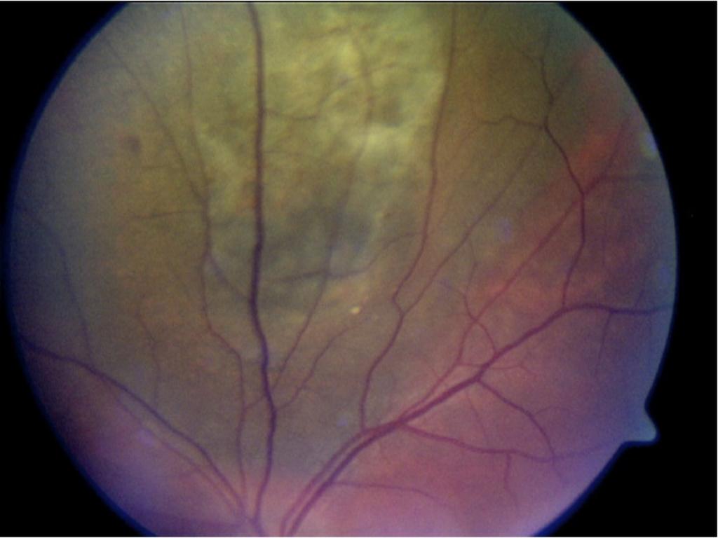 Fig. 4: Photograph of a choroidal melanoma The major clinical differential diagnosis is a benign naevus (1 in 10 ocular lesions).