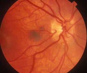 Of 3422 consecutive eyes with choroidal nevus, vision loss at 15 years occurred in 2% of eyes with extrafoveolar nevus and in 26% of eyes with subfoveolar nevus, particularly those with overlying