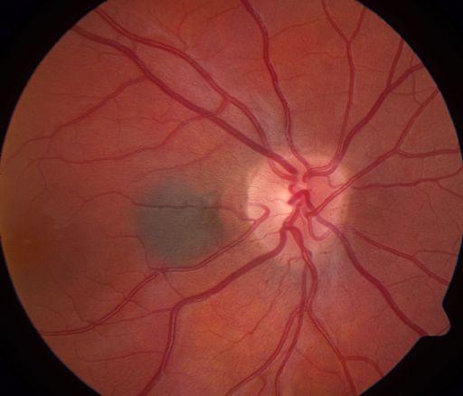 The main outcome measure was visual acuity. Results: The median visual acuity at presentation was 20/20 for eyes with either extrafoveolar or subfoveolar choroidal nevus.