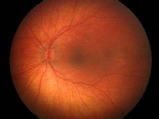 Quadrant uveal melanoma in 8033 eyes Nasal