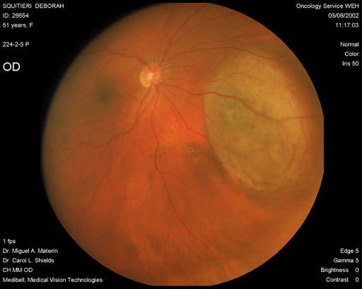 collaborative ocular melanoma study prognosis