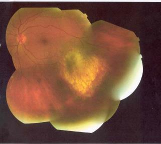 Could the liver cancer have been metastatic from the eye?