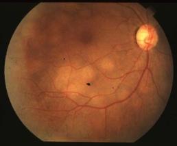 Multiple Metastatic Lesions OU Early IVFA OS Note blocking of the background hyperflouresence