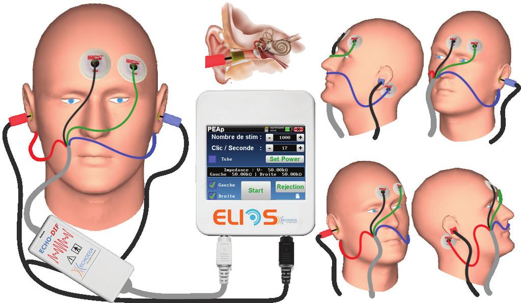1. Setup The following describe measurement of the Auditory Brainstem Response with ELIOS device ABR Equipment: - ELIOS unit. - ECHO-DIF unit. - Acoustic simulator. - Electrophysiology cable.