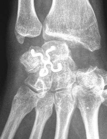 Post-Operative X-Rays
