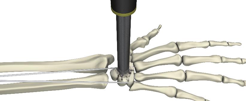 until the stop. Tilt the joint and remove the impactor from the implant.