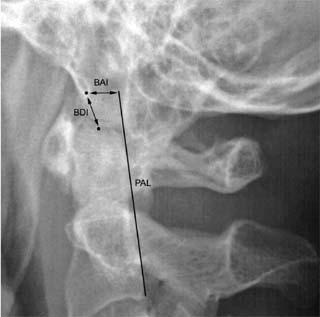Established criteria for diagnosis of AO dislocation include basion to dens interval >12 mm, or