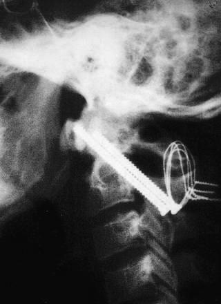 Atlas Fractures Treatment Displaced <6.9 mm Halo vest for 3 mos Displaced >6.
