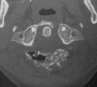 halo vest Posterior C1 2 fusion (unable to tolerate halo) After brace treatment
