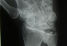 radio-scaphoid OA SLAC 1 as depicted NOT a