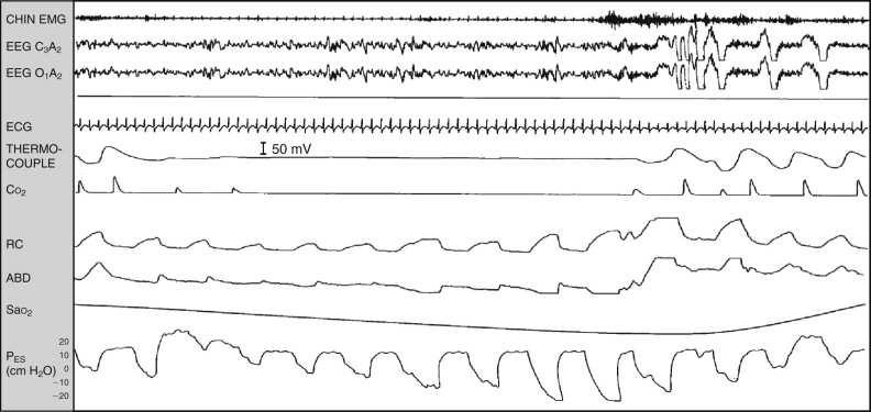 Acute Effects of Apnea on Vascular Risk Apnea Hypoxia Arousals Intrathoracic pressure Sympathetic activation with arousals -> BP peak, Arrhythmia
