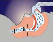 OSA Treatment: CPAP Very effective, resolves OSA in 95% of treated A pneumatic splint for airways Reduces upper airway tone & minute