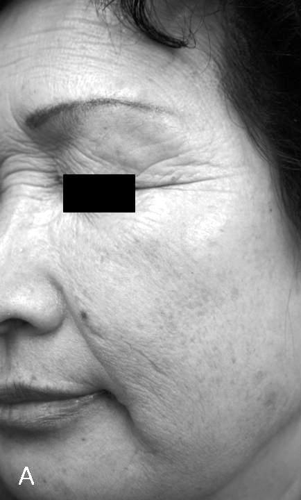 The grading scale of small wrinkles was 1.8, indicating fair improvement (26-50%). Unlike the previous categories, however, hyperpigmented lesions showed minimal improvement (Fig. 3).