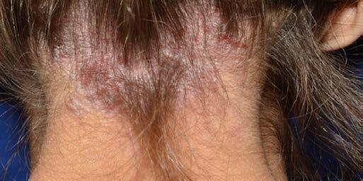 Scalp Psoriasis Response at Week 16 More than 75% (n=167) of enrolled patients presented with