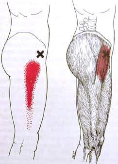 Trigger Point Referred Pain Dry