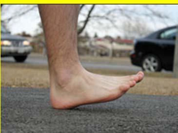 Injuries in barefoot and minimalist runners