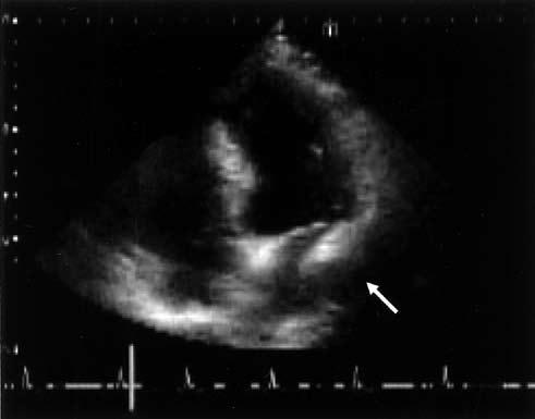 Shimizu et al. Fig. 4. Intraoperative finding 1. Tumor invasion is marked at the junction of the left inferior pulmonary vein to the left atrium. Fig. 3. Echocardiographic finding.