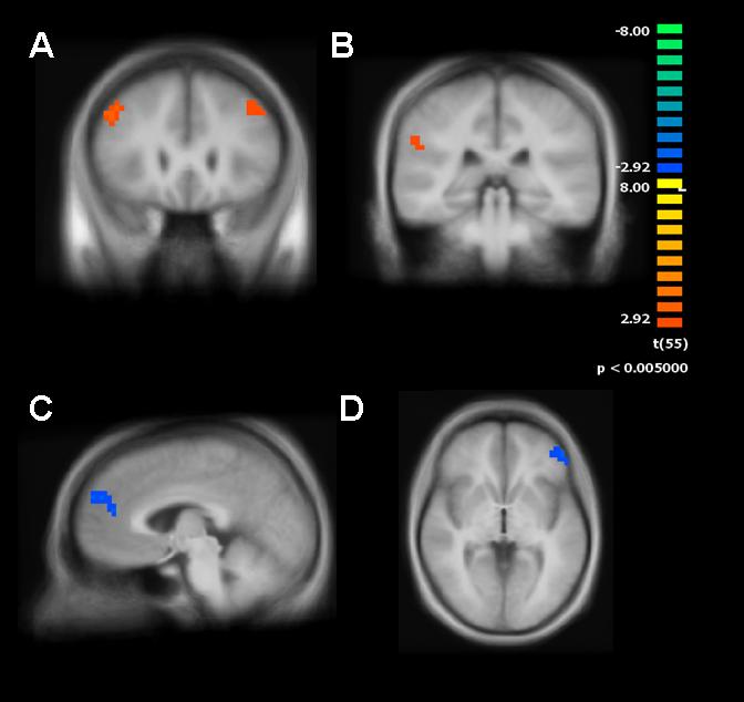 Imaging Results Functional Connectivity Differences Between Schizophrenia and Controls Areas in RED: Controls demonstrated greater positive correlation between seed region and PFC and parietal lobe