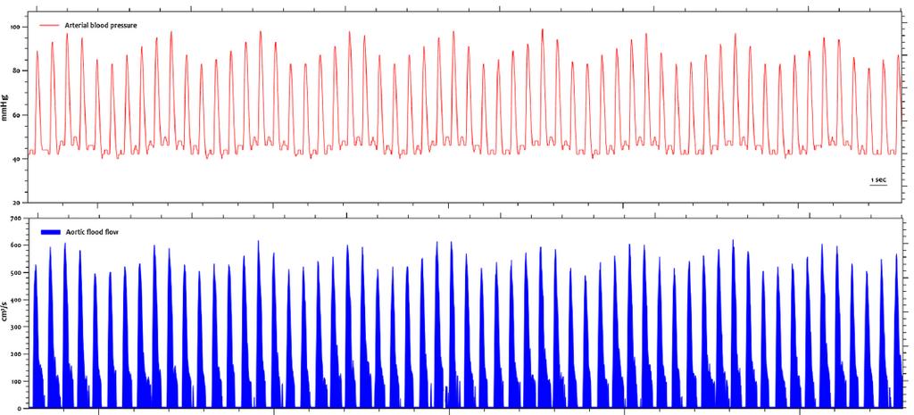 N = 53 80 VEs Dynamic arterial elastance = ratio PPV/SVV during single MV breath All fluid responders (increase CO
