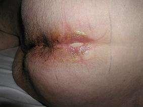 A lesion that is limited to the natal cleft only and has a linear shape is