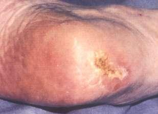 Pressure Ulcer Categories Partial thickness skin loss or damage involving the epidermis and\or
