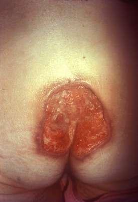 Pressure Ulcer Categories Full thickness skin loss involving damage to or necrosis of