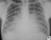 intolerance, fluid retention, which may lead to pulmonary +/-