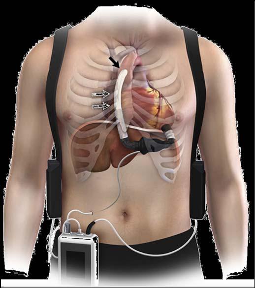 LVAD Circuit Removal of blood from
