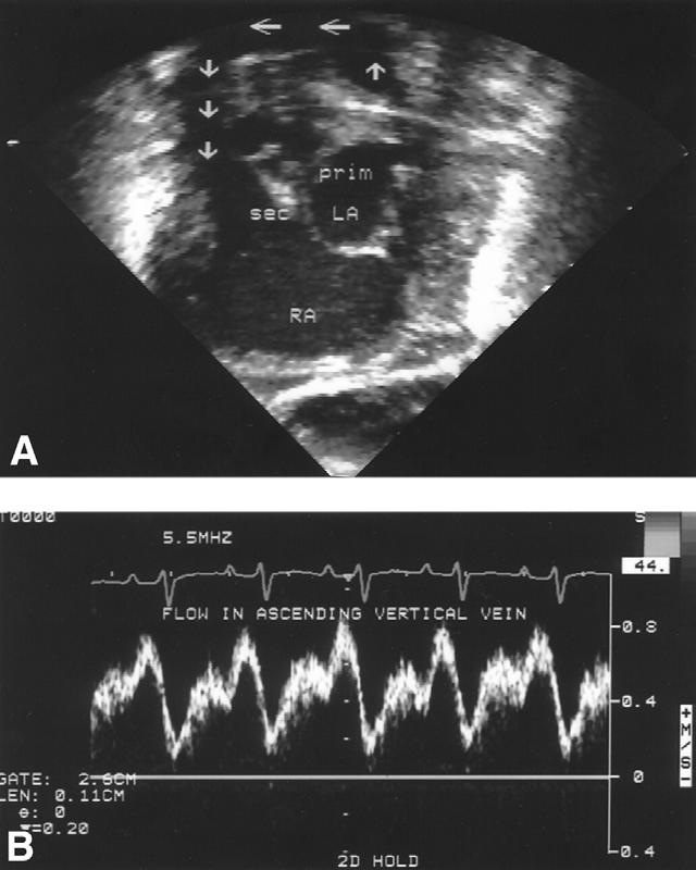 Type A atrial morphology HLHS: Echo Assessment SCAI 2015 12/18 infants Relatively large LA Thick septum secundum Thin septum primum 5/12 with leftward and posterior deviated atrial septum