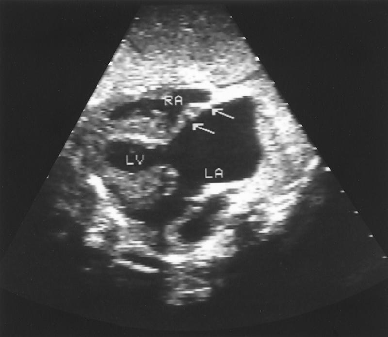 Fetal echocardiographic image of type C atrial morphology HLHS: Echo Assessment SCAI 2015 2/18 Giant LA Thin, rightward bulging atrial septum Severe MR No