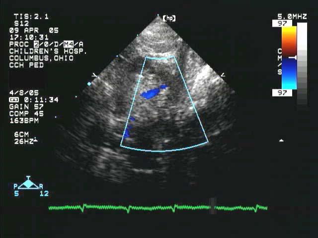 Pre-Hybrid Screening Stenosis at isthmus and at ascending aorta/transverse