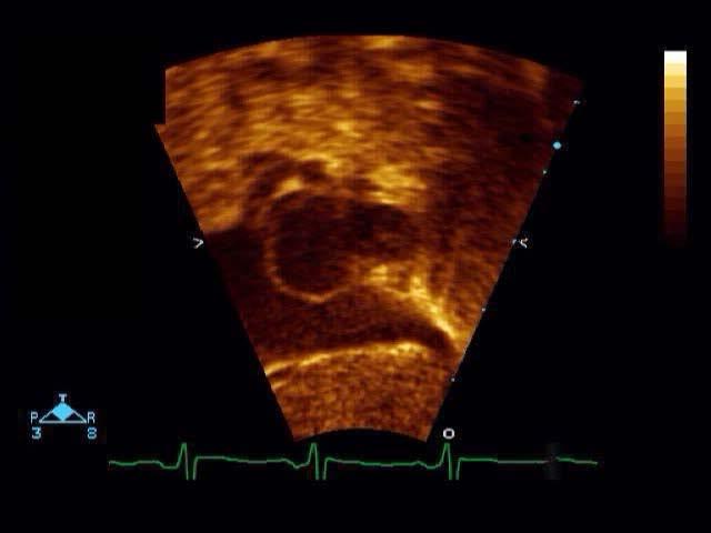 Left Atrium Hypoplastic Thick walled Variable size of ASD Some restriction helpful Intact atrial septum Look for levoatrial