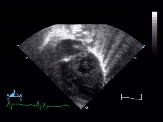 LV Variable hypoplasia Does not extend to cardiac apex LV area < 1.
