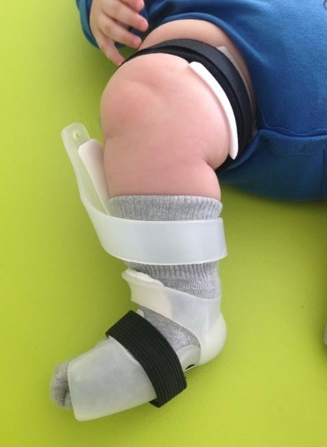 The DTKAFO design approaches clubfoot treatment in an innovative way allowing the infant a full range of motion including rolling over, crawling, standing and ambulating while gently stretching the